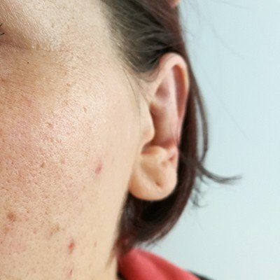 Plastika uší - po zákroku, OB Care Praha Plastika uší - po zákroku, OB Care Praha