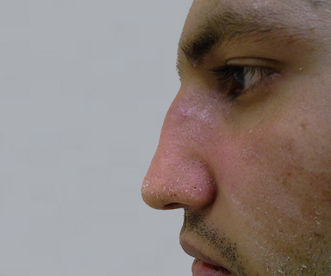 Kompletní nos - po zákroku