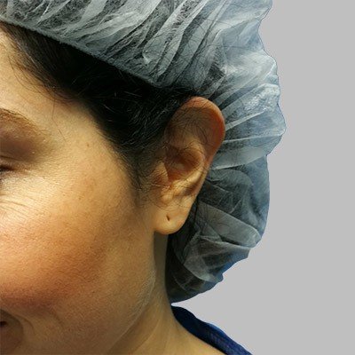 Plastika uší - před zákrokem, OB Care Praha Plastika uší - před zákrokem, OB Care Praha