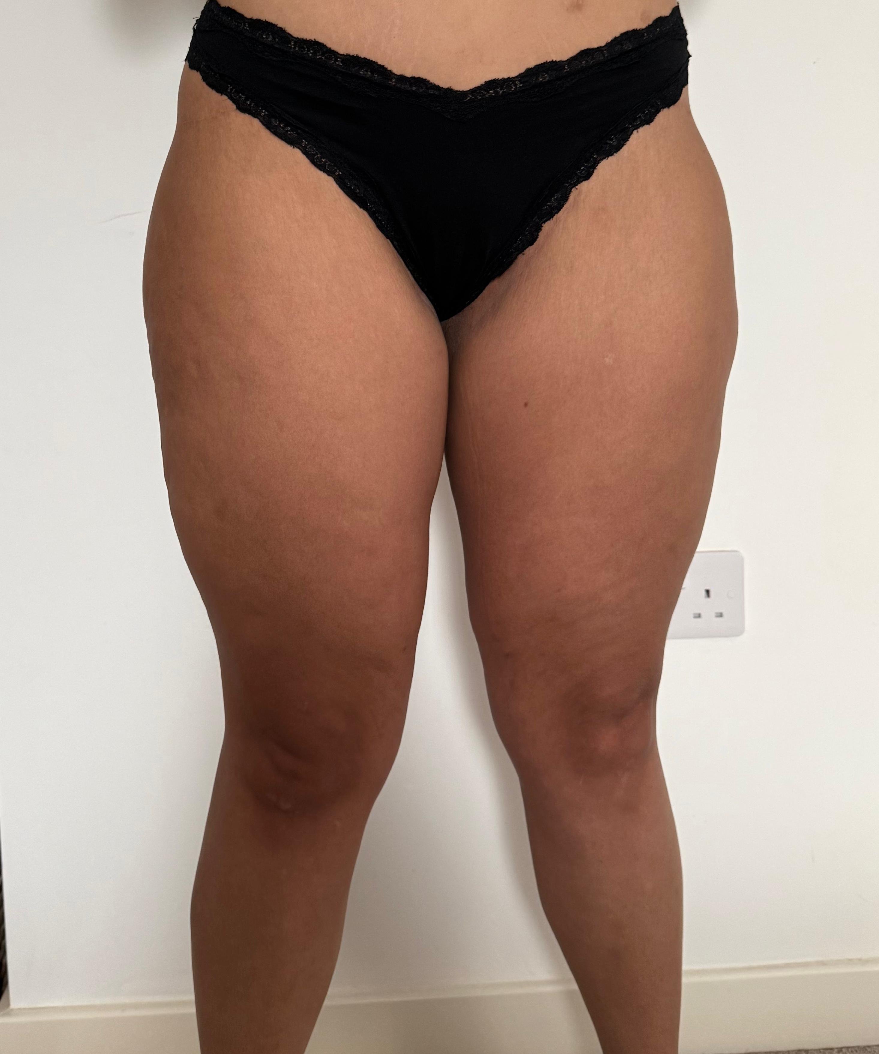 Modelace stehen - po operaci (3 měsíce po operaci) Modelace stehen - po operaci