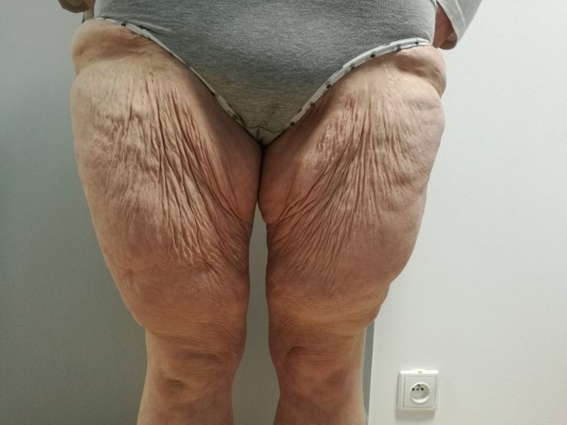 Modelace stehen - před operací Modelace stehen - před operací