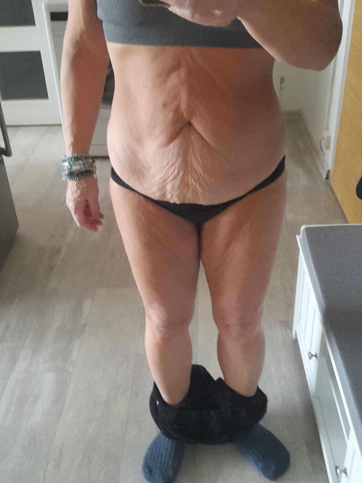 Kožní převis a břicho po velké redukci váhy.