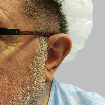 Plastika uší - před zákrokem, OB Care Praha Plastika uší - před zákrokem, OB Care Praha