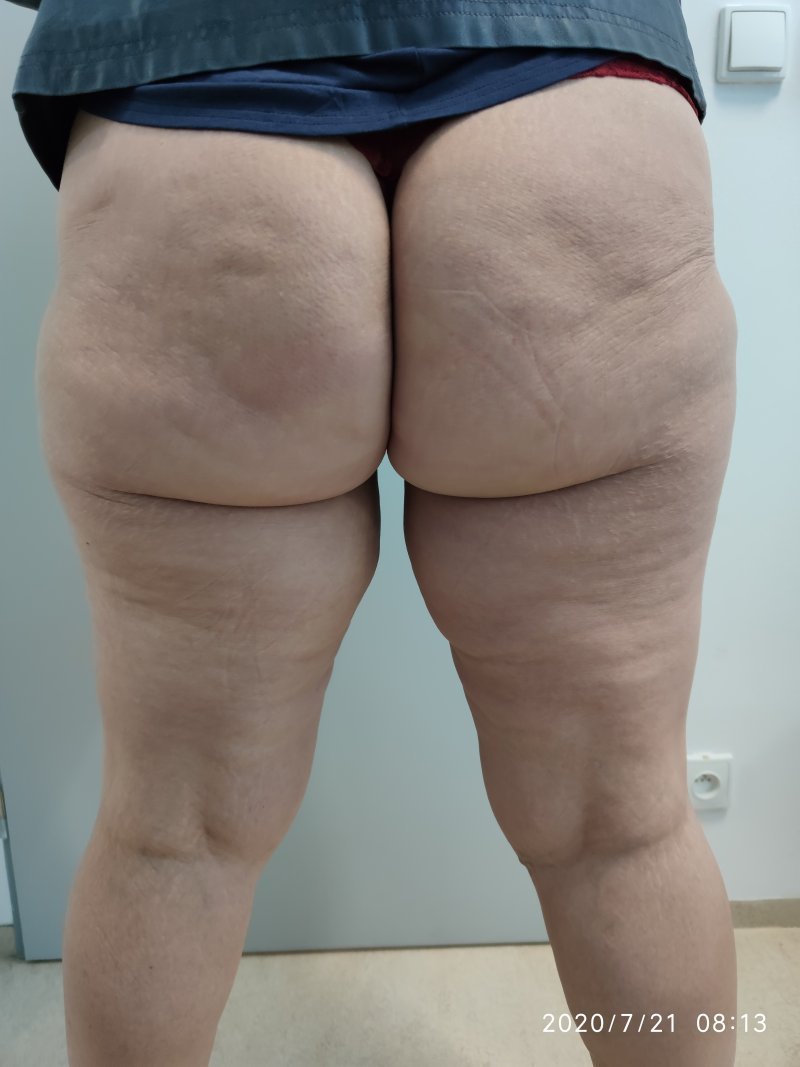 Modelace stehen - před operací Modelace stehen - před operací