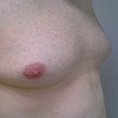 Liposukce mužských prsou