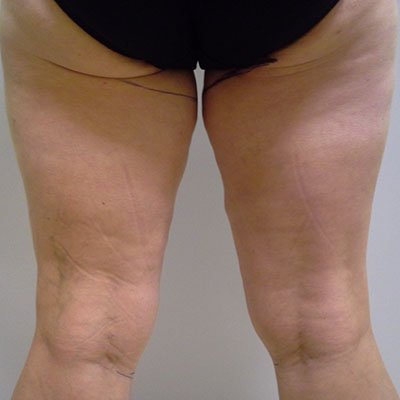 Modelace stehen - před operací Modelace stehen - před operací