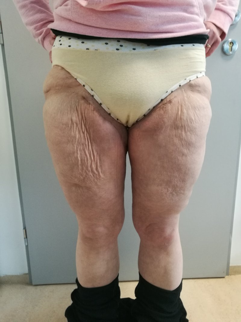 Modelace stehen - po operaci Modelace stehen - po operaci