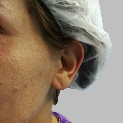 Plastika uší - před zákrokem, OB Care Praha Plastika uší - před zákrokem, OB Care Praha