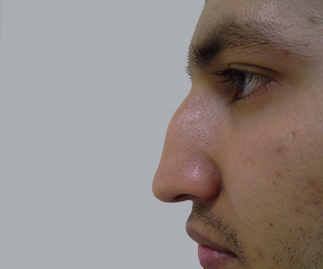 Kompletní nos - před zákrokem