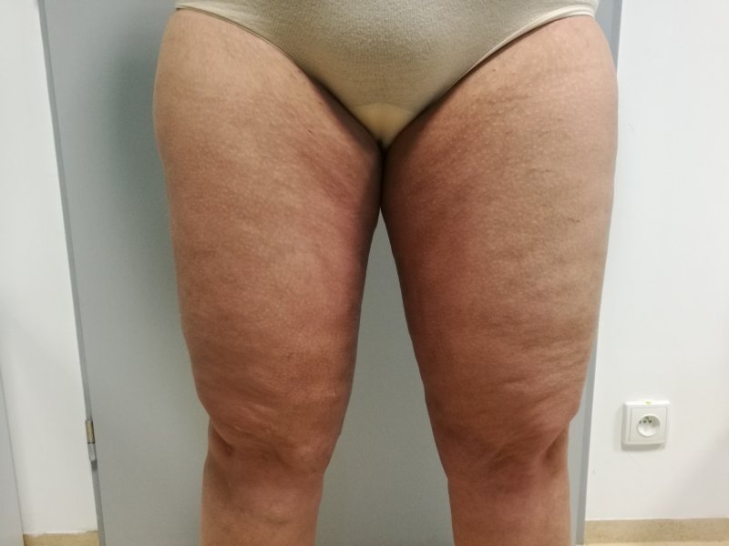 Modelace stehen - po operaci Modelace stehen - po operaci