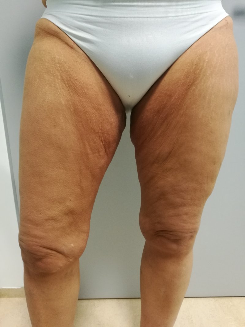 Modelace stehen - před operací Modelace stehen - před operací