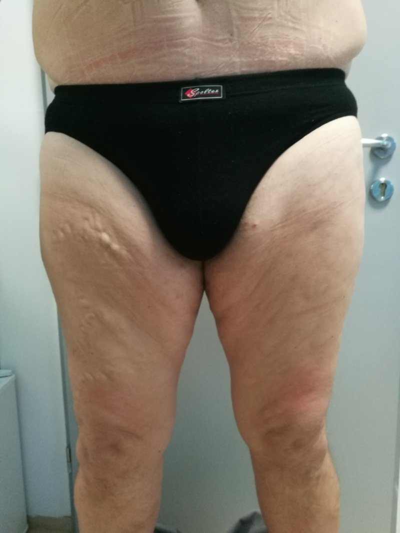 Modelace stehen - před operací Modelace stehen - před operací