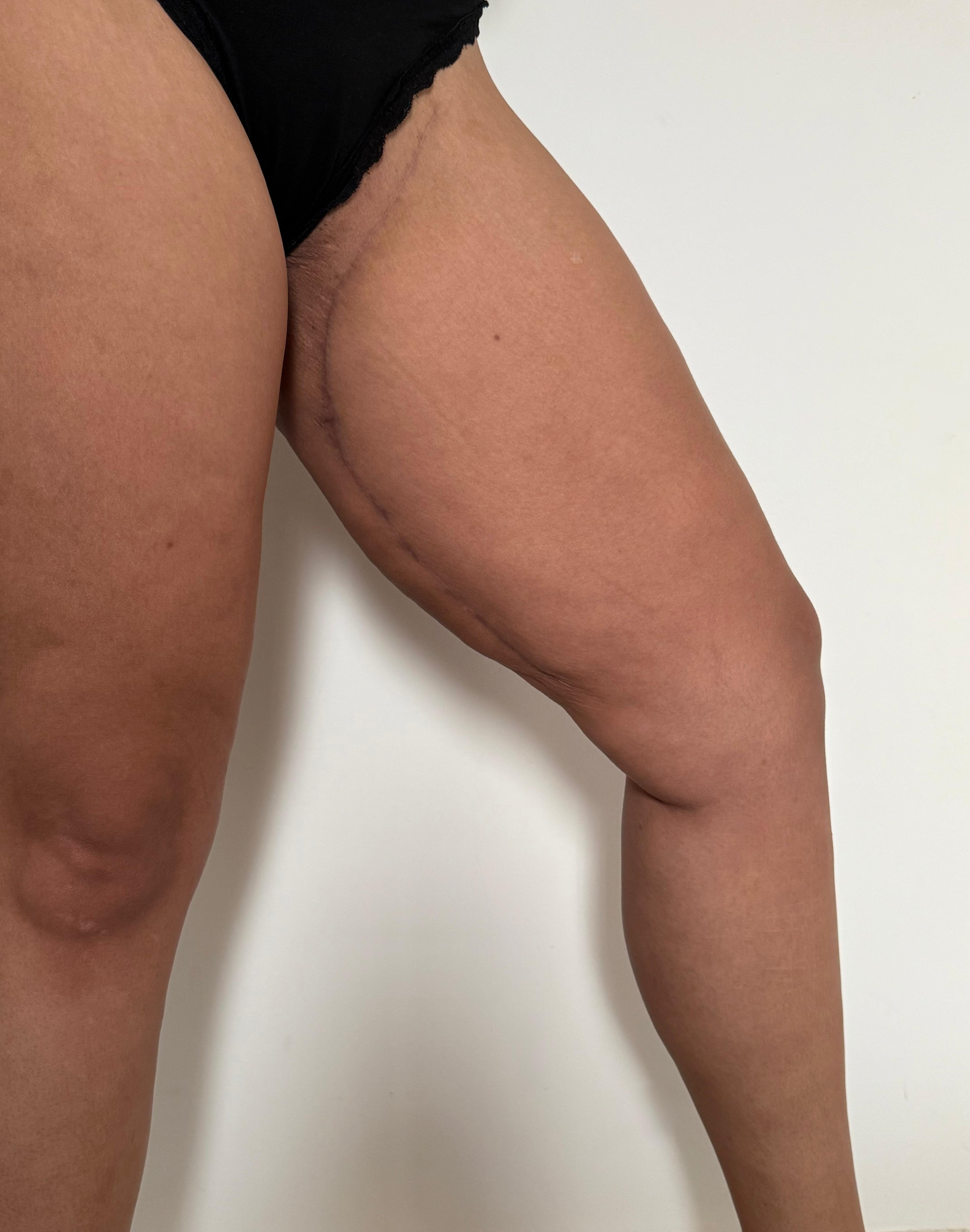 Modelace stehen - ukázka jizvy (po 3 měsících) Modelace stehen - ukázka jizvy (po 3 měsících)