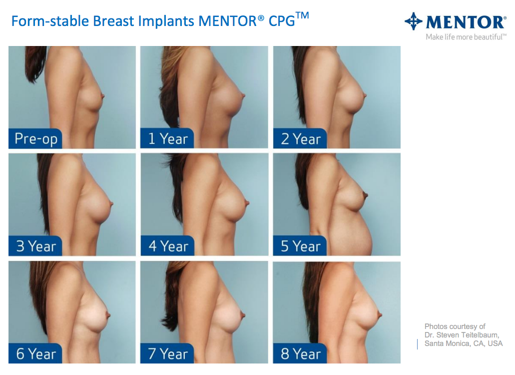 Jak vypadají prsa zvětšená implantáty Mentor po 8 letech? 