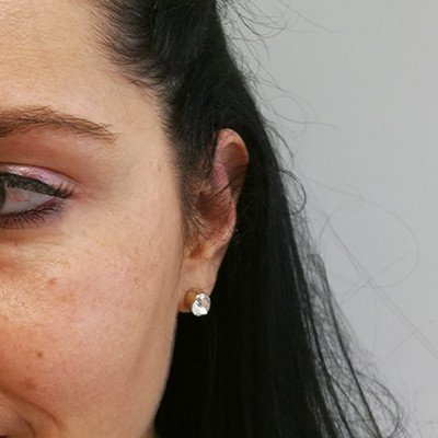 Plastika uší - po zákroku, OB Care Praha Plastika uší - po zákroku, OB Care Praha