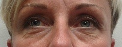 Oblast očí před aplikací Botulotoxinu
