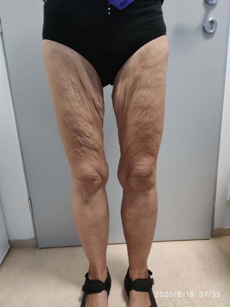 Modelace stehen - před operací Modelace stehen - před operací