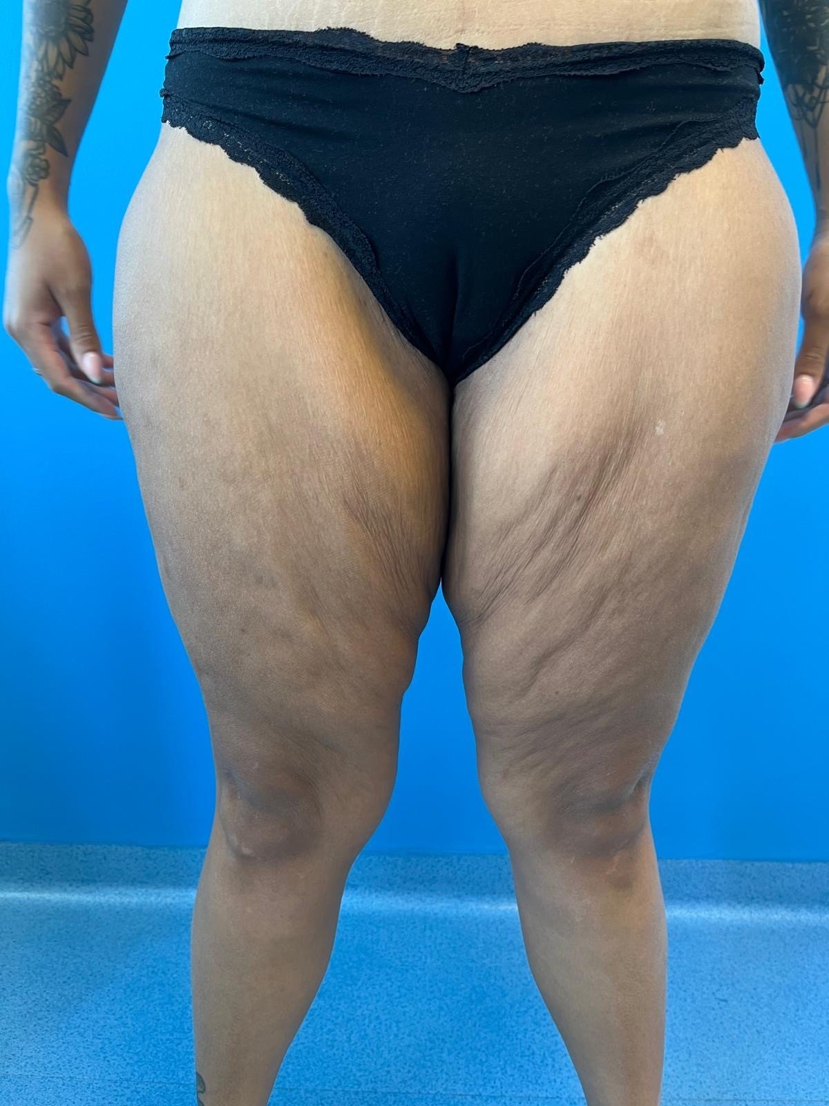 Modelace stehen - před operací Modelace stehen - před operací