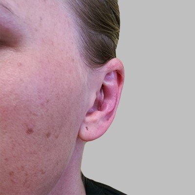 Plastika uší - po zákroku, OB Care Praha Plastika uší - po zákroku, OB Care Praha