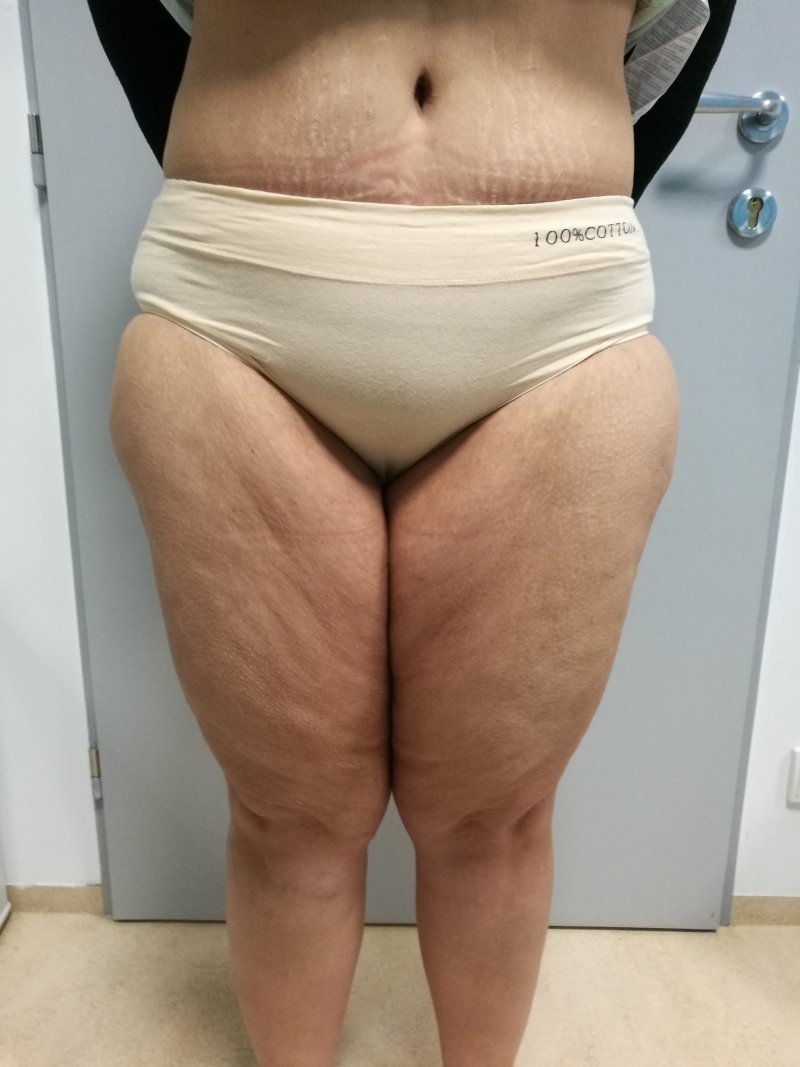 Modelace stehen - před operací Modelace stehen - před operací