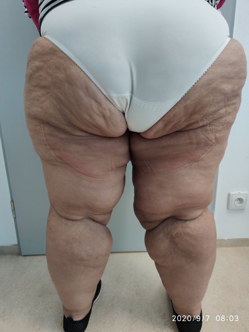 Modelace stehen - po operaci Modelace stehen - po operaci