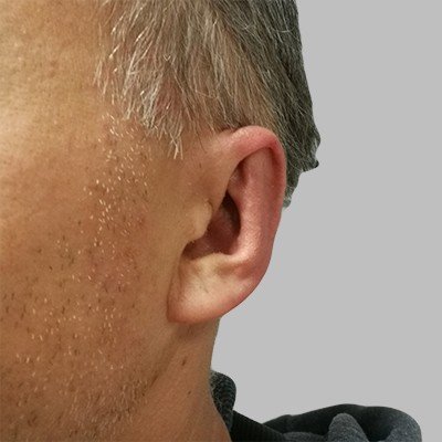 Plastika uší - po zákroku, OB Care Praha Plastika uší - po zákroku, OB Care Praha