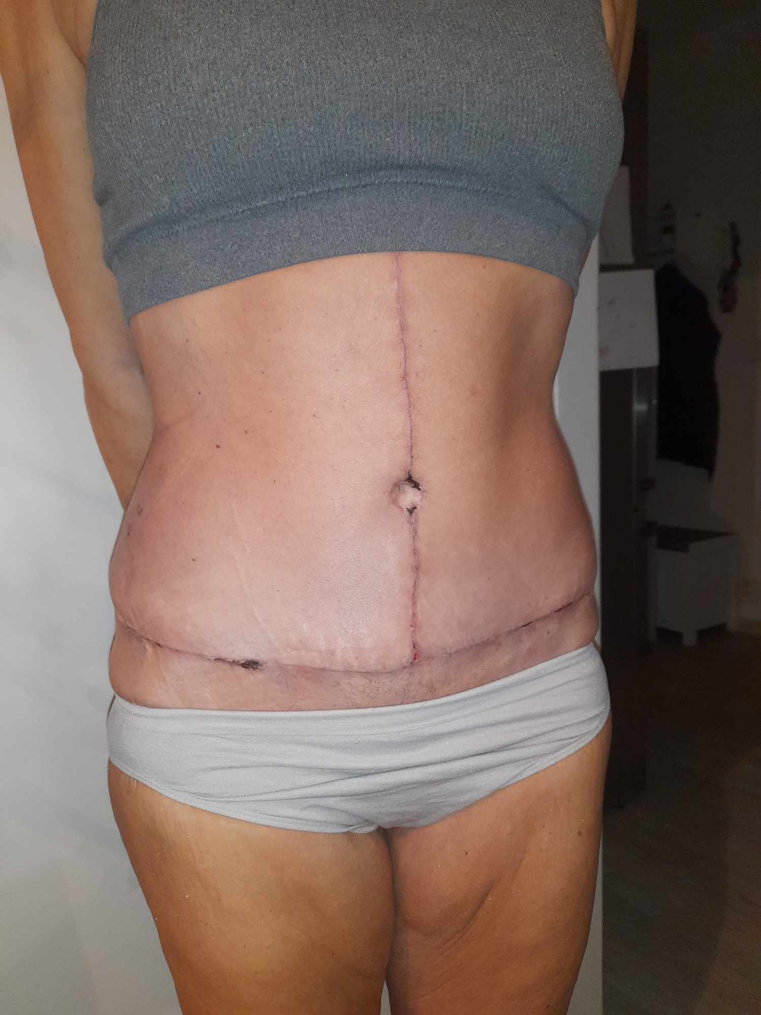 Výsledek plastiky břicha typu FDL s liposukcí několik týdnů po operaci.