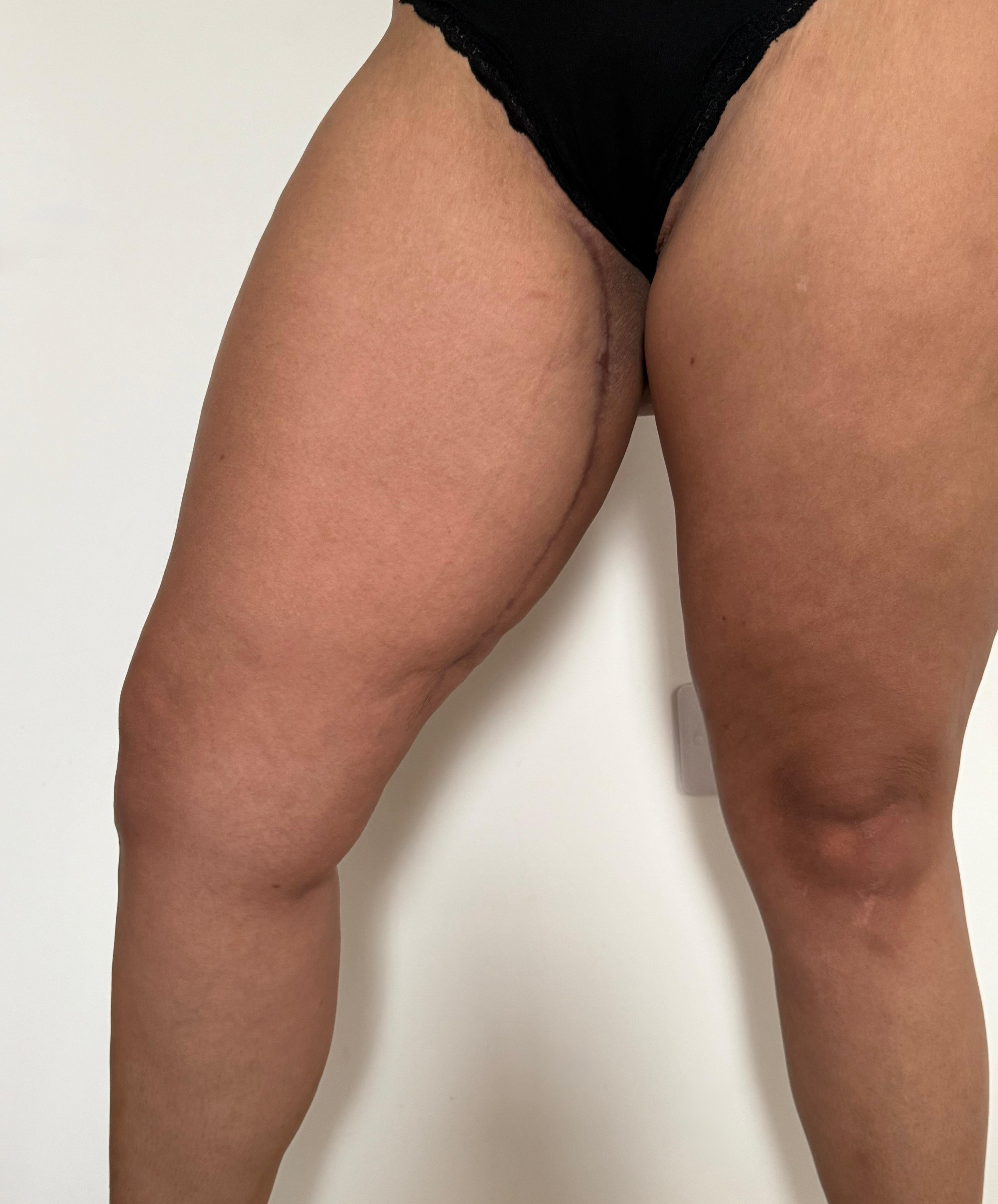 Modelace stehen - ukázka jizvy (po 3 měsících) Modelace stehen - ukázka jizvy (po 3 měsících)