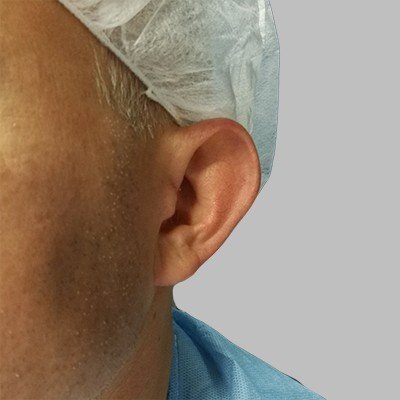 Plastika uší - před zákrokem, OB Care Praha Plastika uší - před zákrokem, OB Care Praha