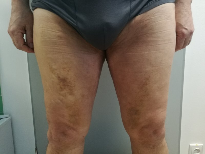 Modelace stehen - po operaci Modelace stehen - po operaci