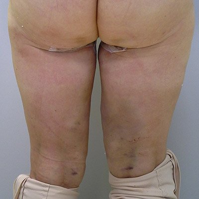 Modelace stehen - po operaci Modelace stehen - po operaci