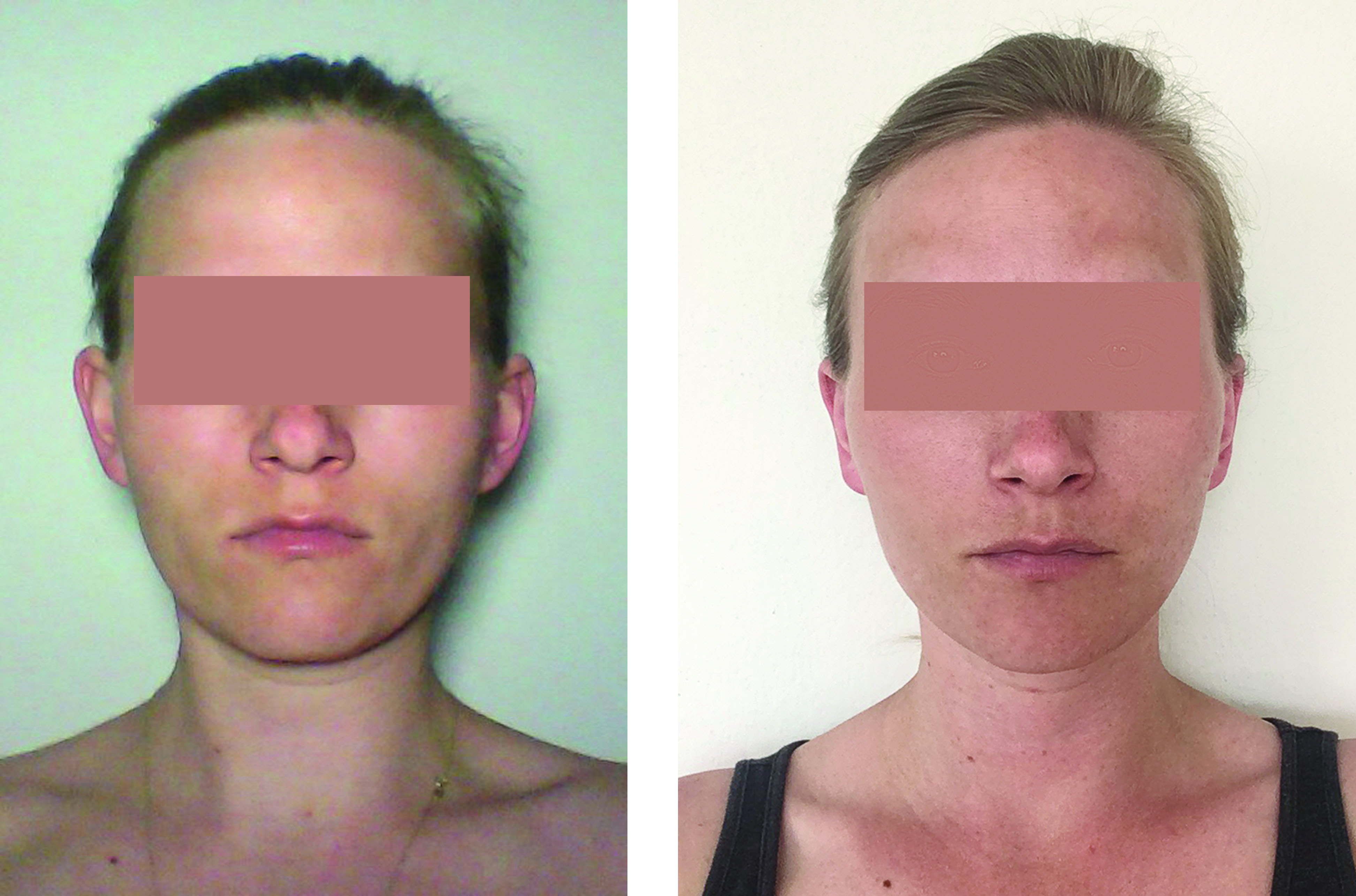 Před a po plastické operaci uší