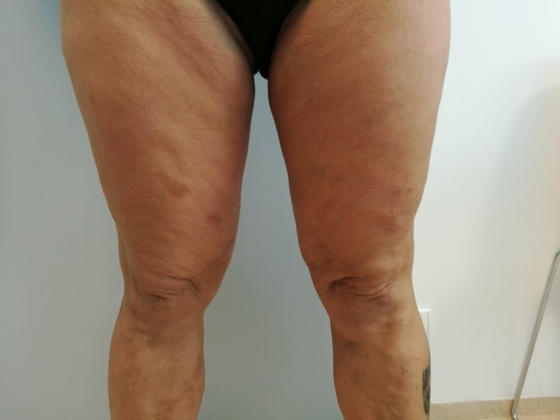 Modelace stehen - po operaci Modelace stehen - po operaci