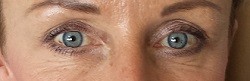 Oblast očí po aplikaci Botulotoxinu