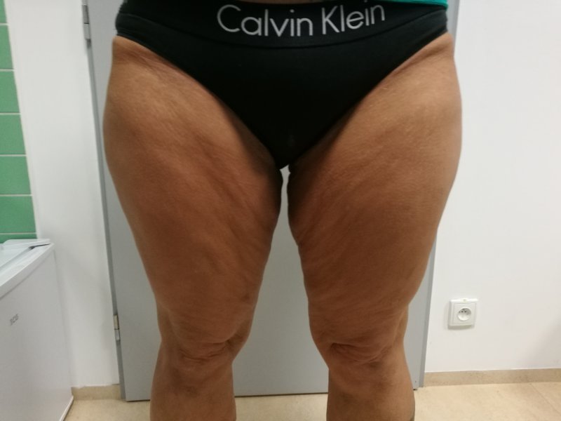 Modelace stehen - před operací Modelace stehen - před operací